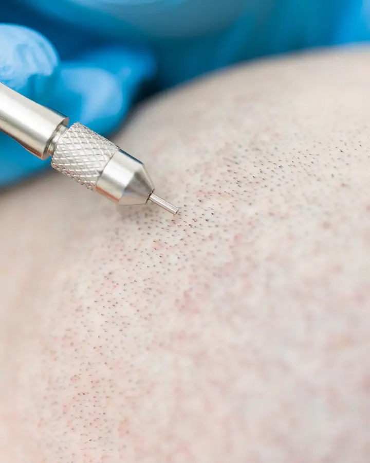 Acercamiento a la implantación directa de cabello (DHI) con implanter