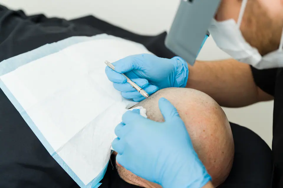 Extracción folicular con técnica FUE en la zona donante durante un injerto capilar