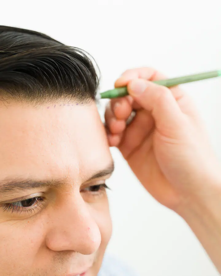 Trazo con lápiz quirúrgico de una línea frontal individualizada según el rostro del paciente